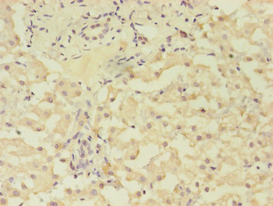 GRK4 Antibody - Immunohistochemistry of paraffin-embedded human liver cancer using GRK4 Antibody at dilution of 1:100