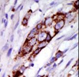 GRK5 Antibody - Formalin-fixed and paraffin-embedded human cancer tissue reacted with the primary antibody, which was peroxidase-conjugated to the secondary antibody, followed by DAB staining. This data demonstrates the use of this antibody for immunohistochemistry; clinical relevance has not been evaluated. BC = breast carcinoma; HC = hepatocarcinoma.