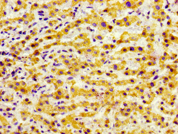 GRK5 Antibody - Immunohistochemistry image of paraffin-embedded human liver cancer at a dilution of 1:100