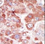 GRK7 / GPRK7 Antibody - Formalin-fixed and paraffin-embedded human cancer tissue reacted with the primary antibody, which was peroxidase-conjugated to the secondary antibody, followed by AEC staining. This data demonstrates the use of this antibody for immunohistochemistry; clinical relevance has not been evaluated. BC = breast carcinoma; HC = hepatocarcinoma.