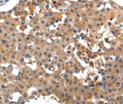 GRM1 / MGLUR1 Antibody - Immunohistochemistry of paraffin-embedded human breast cancer tissue.