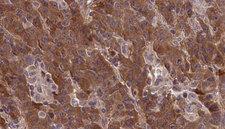 GRM1 / MGLUR1 Antibody - 1:100 staining human liver carcinoma tissues by IHC-P. The sample was formaldehyde fixed and a heat mediated antigen retrieval step in citrate buffer was performed. The sample was then blocked and incubated with the antibody for 1.5 hours at 22°C. An HRP conjugated goat anti-rabbit antibody was used as the secondary.