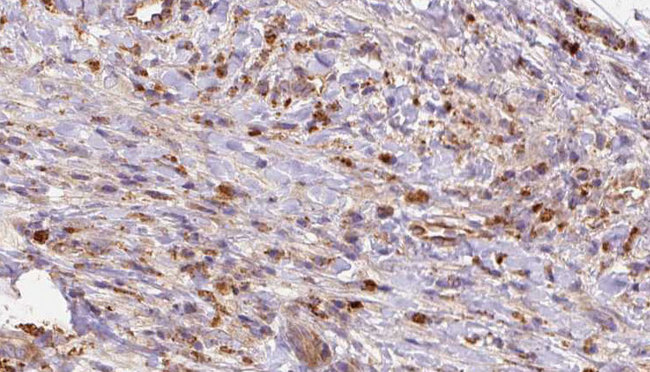 GRM2 / MGLUR2 Antibody - 1:100 staining human liver carcinoma tissues by IHC-P. The sample was formaldehyde fixed and a heat mediated antigen retrieval step in citrate buffer was performed. The sample was then blocked and incubated with the antibody for 1.5 hours at 22°C. An HRP conjugated goat anti-rabbit antibody was used as the secondary.