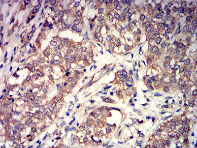 GRM3 / MGLUR3 Antibody - Immunohistochemical analysis of paraffin-embedded bladder cancer tissues using GRM3 mouse mAb with DAB staining.
