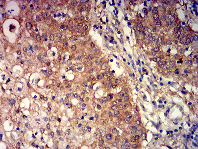 GRM3 / MGLUR3 Antibody - Immunohistochemical analysis of paraffin-embedded stomach cancer tissues using GRM3 mouse mAb with DAB staining.