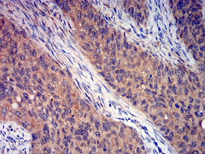 GRM3 / MGLUR3 Antibody - Immunohistochemical analysis of paraffin-embedded cervical cancer tissues using GRM3 mouse mAb with DAB staining.