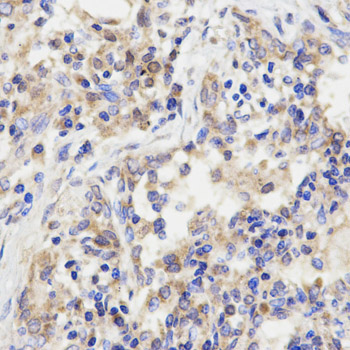 GRM3 / MGLUR3 Antibody - Immunohistochemistry of paraffin-embedded human lung cancer using GRM3 antibody at dilution of 1:200 (x400 lens).
