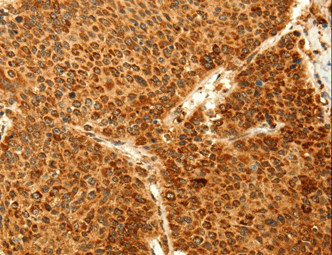 GRM3 / MGLUR3 Antibody - Immunohistochemistry of paraffin-embedded Human liver cancer using GRM3 Polyclonal Antibody at dilution of 1:50.