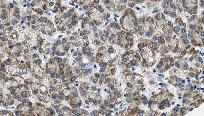 GRM3 / MGLUR3 Antibody - 1:100 staining human liver carcinoma tissues by IHC-P. The sample was formaldehyde fixed and a heat mediated antigen retrieval step in citrate buffer was performed. The sample was then blocked and incubated with the antibody for 1.5 hours at 22°C. An HRP conjugated goat anti-rabbit antibody was used as the secondary.