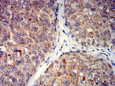 GRM5 / MGLUR5 Antibody - Immunohistochemical analysis of paraffin-embedded bladder cancer tissues using GRM5 mouse mAb with DAB staining.