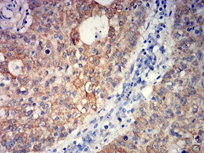 GRM5 / MGLUR5 Antibody - Immunohistochemical analysis of paraffin-embedded stomach cancer tissues using GRM5 mouse mAb with DAB staining.