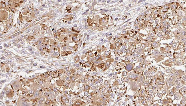 GRM6 / MGLUR6 Antibody - 1:100 staining human Melanoma tissue by IHC-P. The sample was formaldehyde fixed and a heat mediated antigen retrieval step in citrate buffer was performed. The sample was then blocked and incubated with the antibody for 1.5 hours at 22°C. An HRP conjugated goat anti-rabbit antibody was used as the secondary.