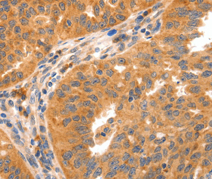 GRM8 / MGLUR8 Antibody - Immunohistochemistry of paraffin-embedded human ovarian cancer tissue.