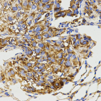 GRM8 / MGLUR8 Antibody - Immunohistochemistry of paraffin-embedded mouse lung metastasis tissue.