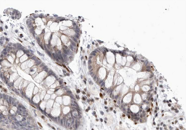 GRM8 / MGLUR8 Antibody - 1:100 staining human colorectal carcinoma tissue by IHC-P. The tissue was formaldehyde fixed and a heat mediated antigen retrieval step in citrate buffer was performed. The tissue was then blocked and incubated with the antibody for 1.5 hours at 22°C. An HRP conjugated goat anti-rabbit antibody was used as the secondary.