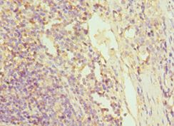 GRN / Granulin Antibody - Immunohistochemistry of paraffin-embedded human rectal cancer using antibody at 1:100 dilution.