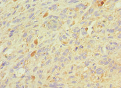 GRN / Granulin Antibody - Immunohistochemistry of paraffin-embedded human melanoma using GRN Antibody at dilution of 1:100