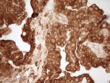 GRN / Granulin Antibody - Immunohistochemical staining of paraffin-embedded Adenocarcinoma of Human ovary tissue using anti-GRN mouse monoclonal antibody. (Heat-induced epitope retrieval by 1 mM EDTA in 10mM Tris, pH8.5, 120C for 3min,
