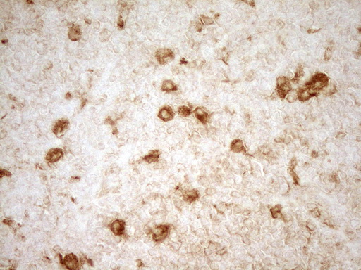 GRN / Granulin Antibody - IHC of paraffin-embedded Human lymphoma tissue using anti-GRN mouse monoclonal antibody. (Heat-induced epitope retrieval by 1 mM EDTA in 10mM Tris, pH8.5, 120°C for 3min).