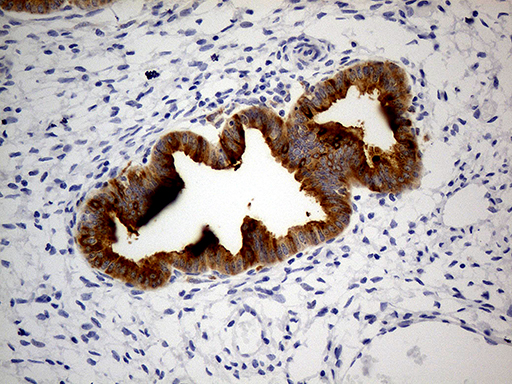 GRN / Granulin Antibody - Immunohistochemical staining of paraffin-embedded Human endometrium tissue within the normal limits using anti-GRN mouse monoclonal antibody. (Heat-induced epitope retrieval by 1mM EDTA in 10mM Tris buffer. (pH8.5) at 120°C for 3 min. (1:500)
