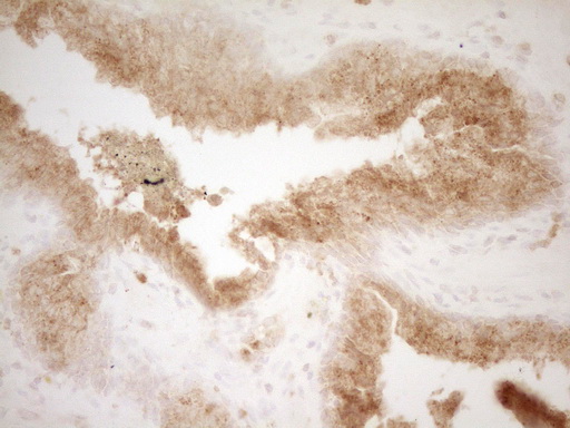 GRN / Granulin Antibody - Immunohistochemical staining of paraffin-embedded Adenocarcinoma of Human endometrium tissue using anti-GRN mouse monoclonal antibody. (Heat-induced epitope retrieval by 1 mM EDTA in 10mM Tris, pH8.5, 120C for 3min,