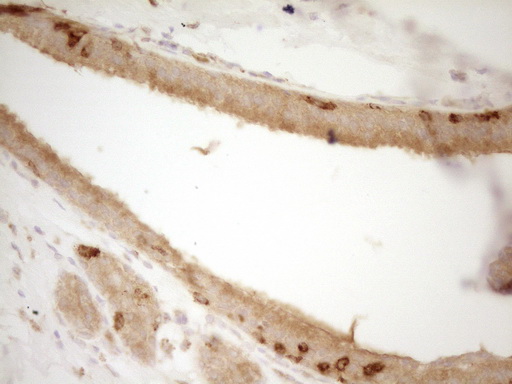 GRN / Granulin Antibody - Immunohistochemical staining of paraffin-embedded Adenocarcinoma of Human breast tissue using anti-GRN mouse monoclonal antibody. (Heat-induced epitope retrieval by 1 mM EDTA in 10mM Tris, pH8.5, 120C for 3min,
