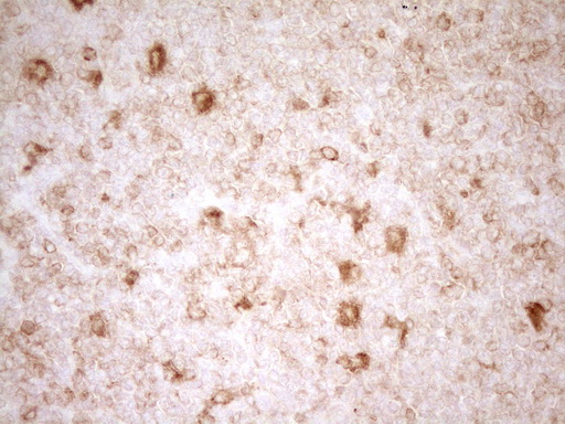 GRN / Granulin Antibody - Immunohistochemical staining of paraffin-embedded Human lymphoma tissue using anti-GRN mouse monoclonal antibody. (Heat-induced epitope retrieval by 1 mM EDTA in 10mM Tris, pH8.5, 120C for 3min,
