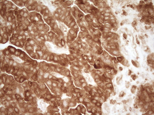 GRN / Granulin Antibody - IHC of paraffin-embedded Adenocarcinoma of Human ovary tissue using anti-GRN mouse monoclonal antibody. (Heat-induced epitope retrieval by 1 mM EDTA in 10mM Tris, pH8.5, 120°C for 3min).
