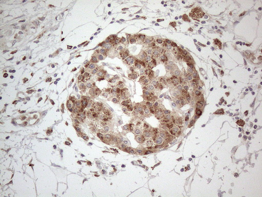 GRN / Granulin Antibody - Immunohistochemical staining of paraffin-embedded Carcinoma of Human pancreas tissue using anti-GRN mouse monoclonal antibody. (Heat-induced epitope retrieval by 1mM EDTA in 10mM Tris buffer. (pH8.5) at 120°C for 3 min. (1:150)