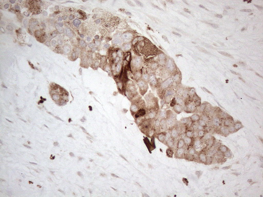 GRN / Granulin Antibody - Immunohistochemical staining of paraffin-embedded Adenocarcinoma of Human endometrium tissue using anti-GRN mouse monoclonal antibody. (Heat-induced epitope retrieval by 1mM EDTA in 10mM Tris buffer. (pH8.5) at 120°C for 3 min. (1:150)