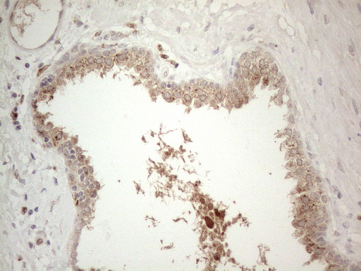 GRN / Granulin Antibody - Immunohistochemical staining of paraffin-embedded Carcinoma of Human prostate tissue using anti-GRN mouse monoclonal antibody. (Heat-induced epitope retrieval by 1mM EDTA in 10mM Tris buffer. (pH8.5) at 120°C for 3 min. (1:150)