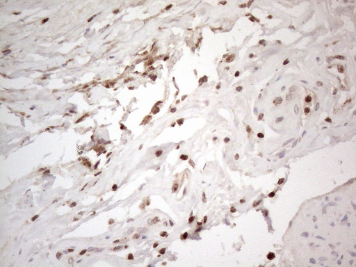 GRN / Granulin Antibody - Immunohistochemical staining of paraffin-embedded Carcinoma of Human bladder tissue using anti-GRN mouse monoclonal antibody. (Heat-induced epitope retrieval by 1mM EDTA in 10mM Tris buffer. (pH8.5) at 120°C for 3 min. (1:150)