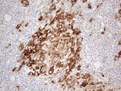 GRN / Granulin Antibody - Immunohistochemical staining of paraffin-embedded Human lymph node tissue within the normal limits using anti-GRN mouse monoclonal antibody. (Heat-induced epitope retrieval by 1mM EDTA in 10mM Tris buffer. (pH8.5) at 120°C for 3 min. (1:150)
