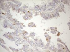 GRN / Granulin Antibody - Immunohistochemical staining of paraffin-embedded Adenocarcinoma of Human ovary tissue using anti-GRN mouse monoclonal antibody. (Heat-induced epitope retrieval by 1mM EDTA in 10mM Tris buffer. (pH8.5) at 120°C for 3 min. (1:150)