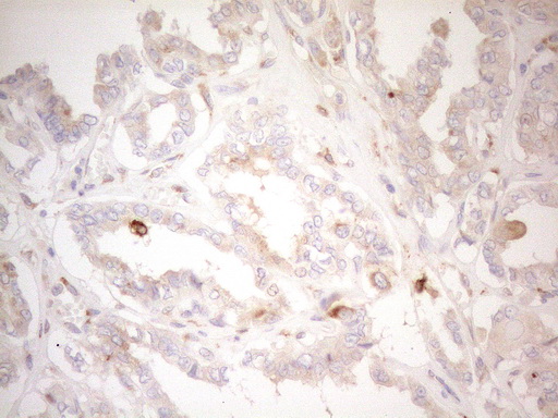 GRN / Granulin Antibody - Immunohistochemical staining of paraffin-embedded Carcinoma of Human thyroid tissue using anti-GRN mouse monoclonal antibody. (Heat-induced epitope retrieval by 1mM EDTA in 10mM Tris buffer. (pH8.5) at 120°C for 3 min. (1:150)