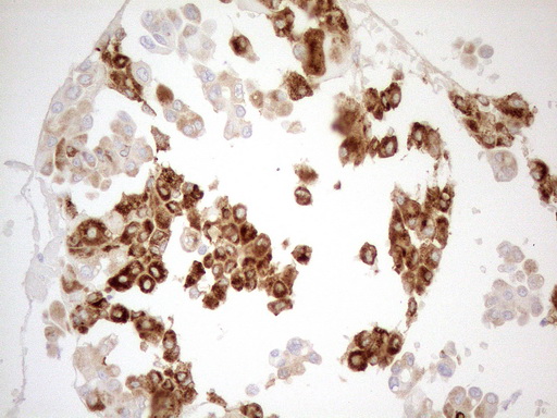 GRN / Granulin Antibody - Immunohistochemical staining of paraffin-embedded Human endometrium tissue using anti-GRN mouse monoclonal antibody. (Heat-induced epitope retrieval by 1mM EDTA in 10mM Tris buffer. (pH8.5) at 120°C for 3 min. (1:150)