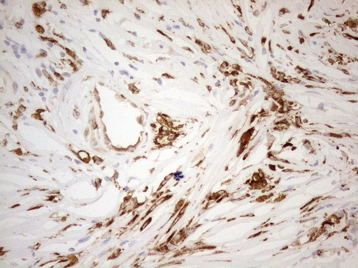 GRN / Granulin Antibody - Immunohistochemical staining of paraffin-embedded Adenocarcinoma of Human breast tissue using anti-GRN mouse monoclonal antibody. (Heat-induced epitope retrieval by 1mM EDTA in 10mM Tris buffer. (pH8.5) at 120°C for 3 min. (1:150)