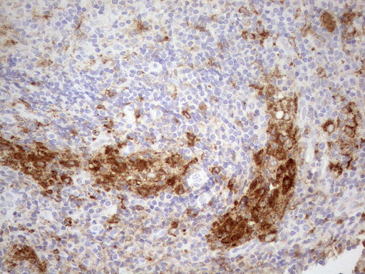 GRN / Granulin Antibody - Immunohistochemical staining of paraffin-embedded Human lymph node tissue using anti-GRN mouse monoclonal antibody. (Heat-induced epitope retrieval by 1mM EDTA in 10mM Tris buffer. (pH8.5) at 120°C for 3 min. (1:150)