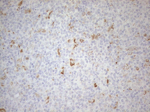 GRN / Granulin Antibody - Immunohistochemical staining of paraffin-embedded Human lymphoma tissue using anti-GRN mouse monoclonal antibody. (Heat-induced epitope retrieval by 1mM EDTA in 10mM Tris buffer. (pH8.5) at 120°C for 3 min. (1:150)