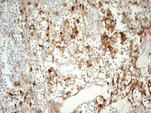 GRN / Granulin Antibody - Immunohistochemical staining of paraffin-embedded Human tonsil using anti-GRN mouse monoclonal antibody. (Heat-induced epitope retrieval by 1mM EDTA in 10mM Tris buffer. (pH8.5) at 120°C for 3 min. (1:150)