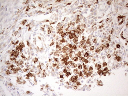 GRN / Granulin Antibody - Immunohistochemical staining of paraffin-embedded Adenocarcinoma of Human colon tissue using anti-GRN mouse monoclonal antibody. (Heat-induced epitope retrieval by 1mM EDTA in 10mM Tris buffer. (pH8.5) at 120°C for 3 min. (1:150)