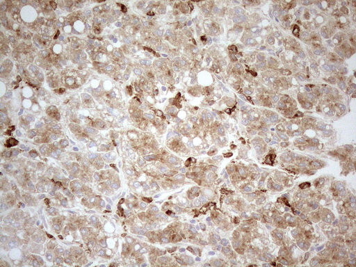 GRN / Granulin Antibody - Immunohistochemical staining of paraffin-embedded Human liver tissue using anti-GRN mouse monoclonal antibody. (Heat-induced epitope retrieval by 1mM EDTA in 10mM Tris buffer. (pH8.5) at 120°C for 3 min. (1:150)
