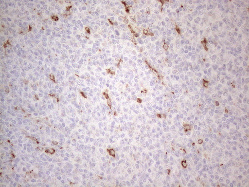 GRN / Granulin Antibody - Immunohistochemical staining of paraffin-embedded Human lymphoma tissue using anti-GRN mouse monoclonal antibody. (Heat-induced epitope retrieval by 1mM EDTA in 10mM Tris buffer. (pH8.5) at 120°C for 3 min. (1:150)