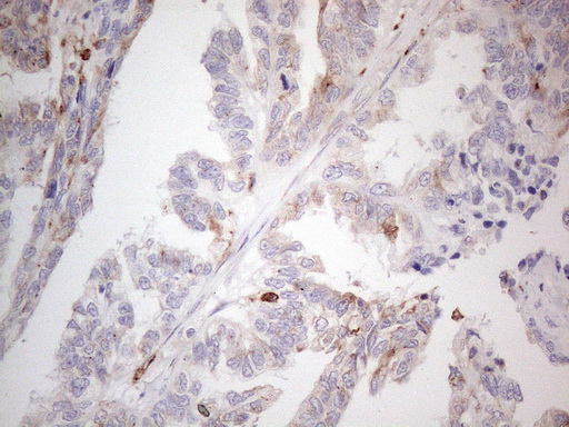 GRN / Granulin Antibody - Immunohistochemical staining of paraffin-embedded Adenocarcinoma of Human ovary tissue using anti-GRN mouse monoclonal antibody. (Heat-induced epitope retrieval by 1mM EDTA in 10mM Tris buffer. (pH8.5) at 120°C for 3 min. (1:150)