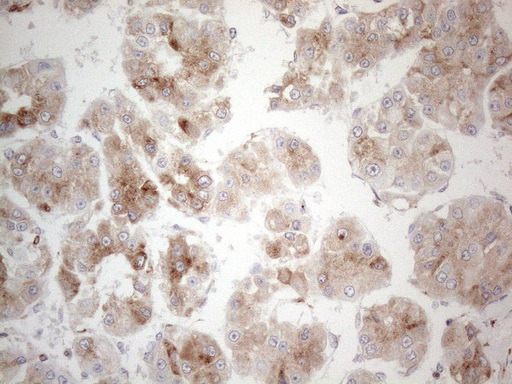 GRN / Granulin Antibody - Immunohistochemical staining of paraffin-embedded Carcinoma of Human liver tissue using anti-GRN mouse monoclonal antibody. (Heat-induced epitope retrieval by 1mM EDTA in 10mM Tris buffer. (pH8.5) at 120°C for 3 min. (1:150)