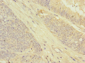 GRPEL2 Antibody - Immunohistochemistry of paraffin-embedded human colon cancer at dilution 1:100