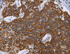 GRPR Antibody - Immunohistochemistry of paraffin-embedded Human cervical cancer using GRPR Polyclonal Antibody at dilution of 1:40.
