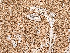 GRSF1 Antibody - Immunohistochemistry of paraffin-embedded Human ovarian cancer tissue  using GRSF1 Polyclonal Antibody at dilution of 1:30(×200)