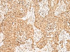 GRSF1 Antibody - Immunohistochemistry of paraffin-embedded Human ovarian cancer tissue  using GRSF1 Polyclonal Antibody at dilution of 1:25(×200)