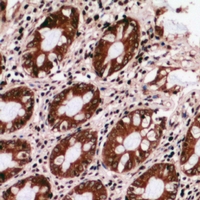 GRTP1 Antibody - Immunohistochemical analysis of GRTP1 staining in human colon cancer formalin fixed paraffin embedded tissue section. The section was pre-treated using heat mediated antigen retrieval with sodium citrate buffer (pH 6.0). The section was then incubated with the antibody at room temperature and detected using an HRP conjugated compact polymer system. DAB was used as the chromogen. The section was then counterstained with haematoxylin and mounted with DPX.
